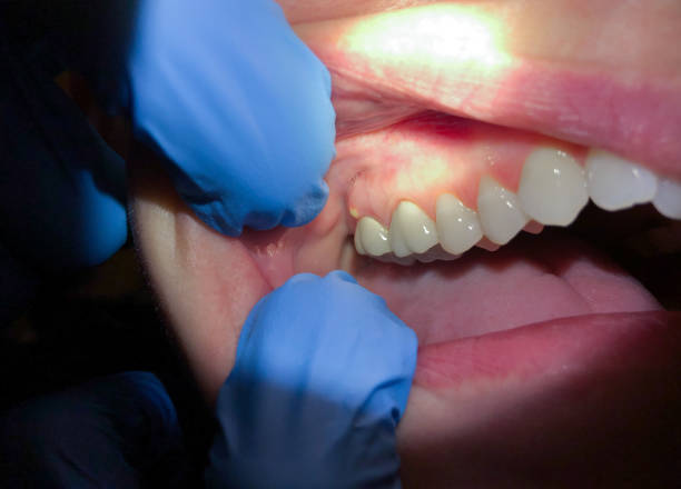 Best Emergency Treatment for Dental Infections or Abscesses in Vidor, TX