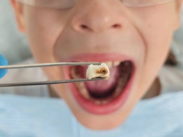 Best Emergency Dental Care for Broken or Chipped Teeth in Vidor, TX